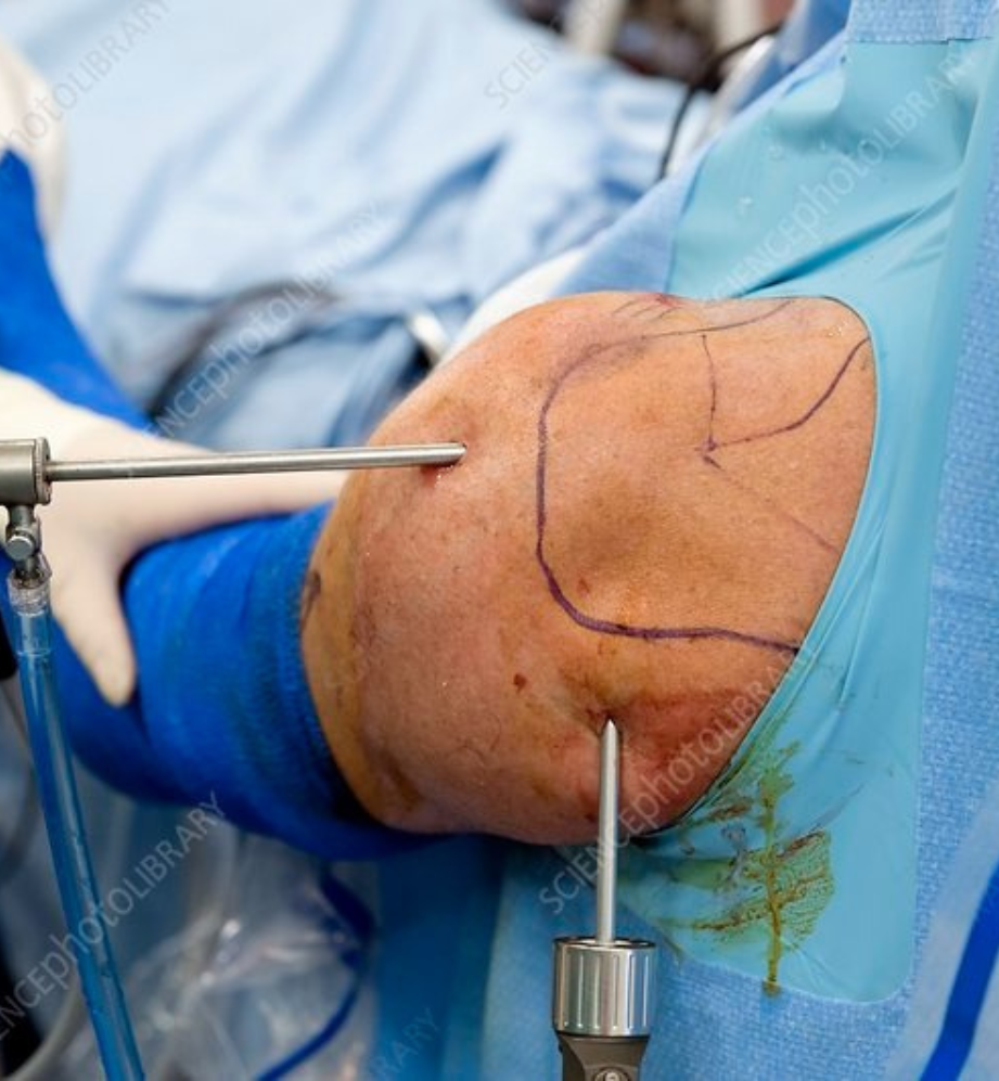 Shoulder Arthroscopy
